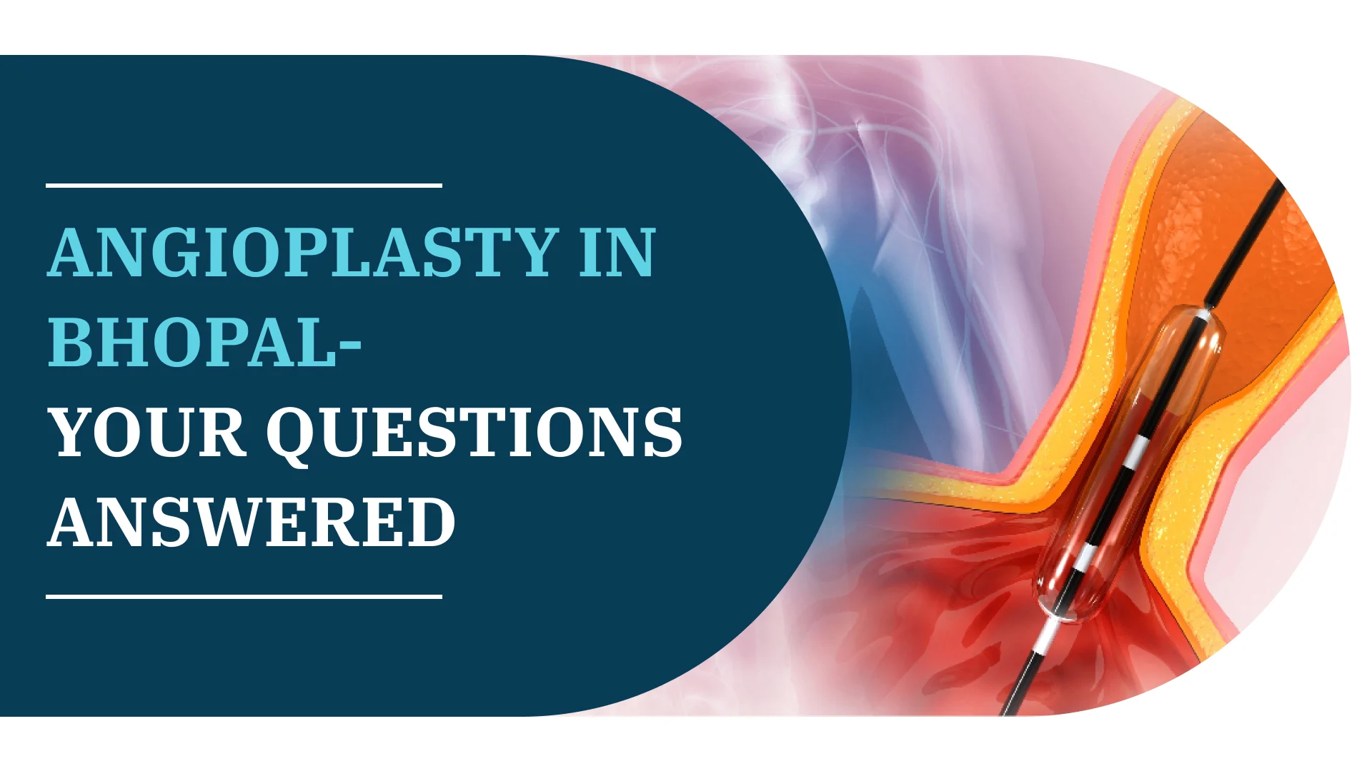 Angioplasty In Bhopal – Your Questions Answered