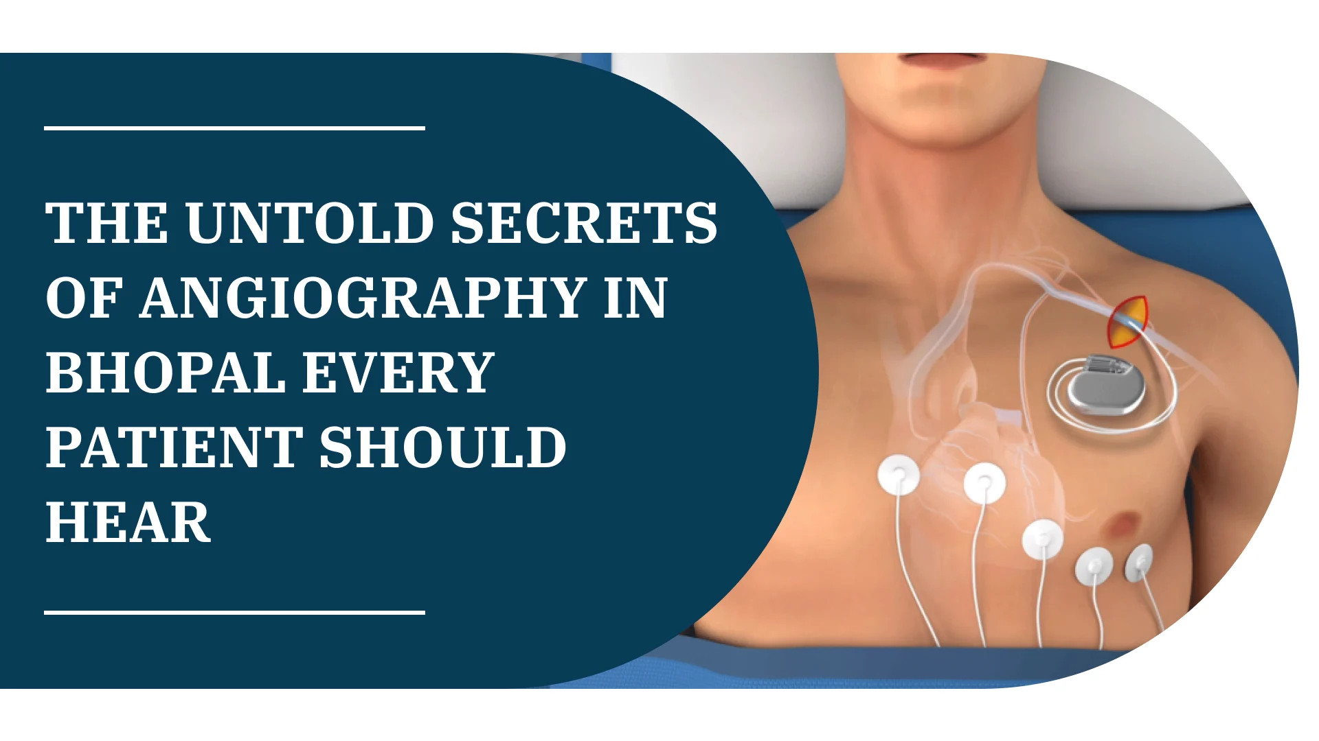 The Untold Secrets of Angiography in Bhopal Every Patient Should Hear
