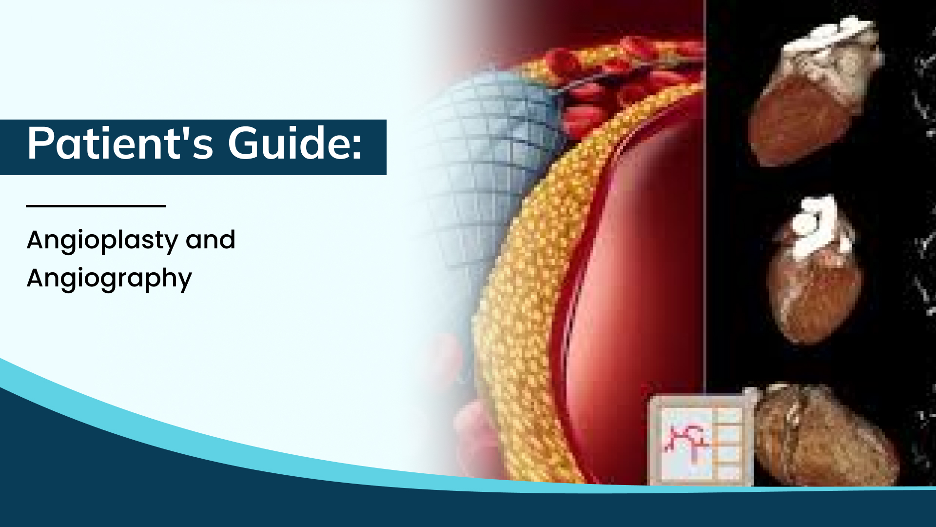 Understanding Angioplasty and Angiography: A Patient’s Complete Guide to Heart Procedures in Bhopal