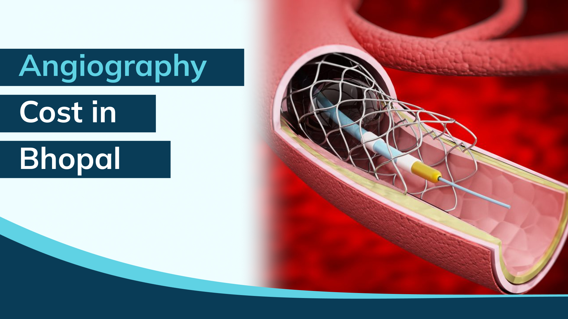 Angiography Cost in Bhopal: What Really Determines the Price