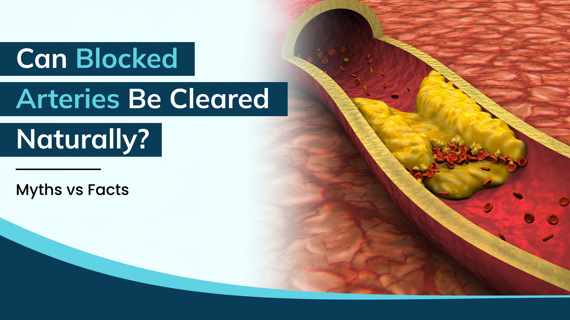 Can Blocked Heart Arteries Be Cleared Naturally Without Angioplasty? Myths vs Facts